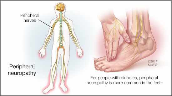 Diabetic Neuropathy Link&nbsp;Share