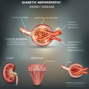 Image result for Diabetic Nephropathy